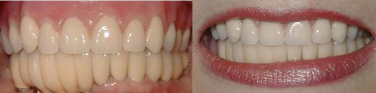 Before and after dental veneers transformation showing improved tooth color and alignment.