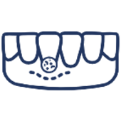 Dental implant icon showing tooth crown and implant post in jawbone illustration.