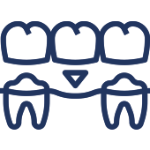 Dental bridge connecting three teeth with crowns, illustrating restorative dentistry procedure.