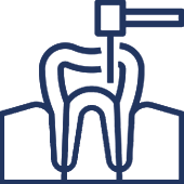 Dental root canal treatment illustration with tooth cross-section and endodontic instruments.
