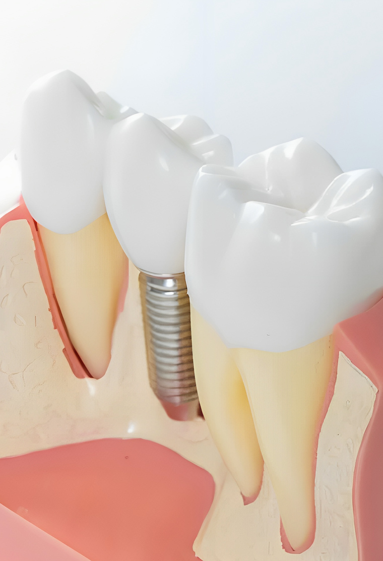 Dental implant model showing titanium post with crown between natural teeth on gum tissue.