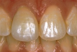 Close-up of upper front teeth showing natural tooth color and dental work results.