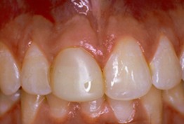 Close-up of upper front teeth showing natural tooth color and dental alignment in clinical setting.