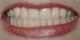 Close-up of a patient's smile showing whitened, evenly aligned upper teeth with pink lips.