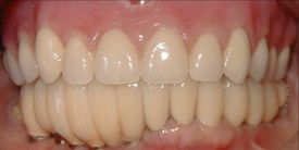 Close-up of natural-looking dental crowns and veneers showing perfect smile alignment and tooth restoration.