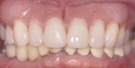 Close-up of upper front teeth showing cosmetic dental work and natural tooth appearance.