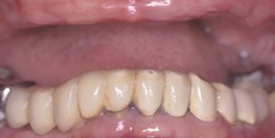 Close-up view of natural-looking dental implants or crowns in lower jaw, showing proper alignment and tooth color matching.