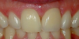 Close-up of upper front teeth showing dental work and natural tooth coloration differences.