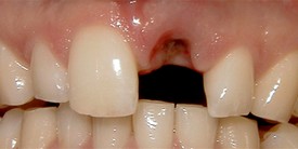 Close-up of dental implant procedure showing gap between natural teeth with dark implant socket visible.