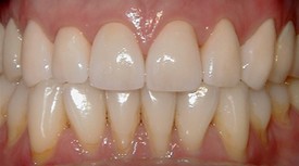 Close-up of healthy white teeth and gums showing dental work results in clinical setting.