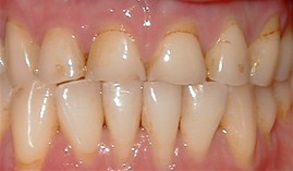 Close-up of upper front teeth showing natural tooth color and alignment in dental setting.