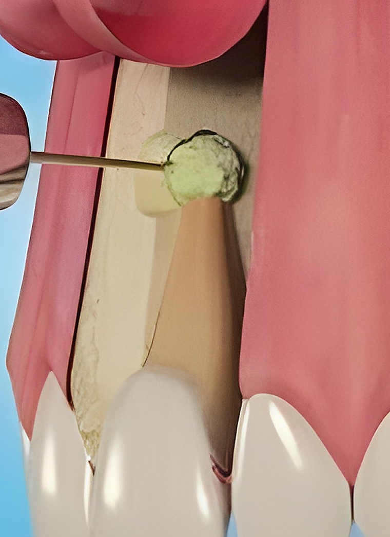 Dentist holding dental mirror examining patient's mouth during oral examination