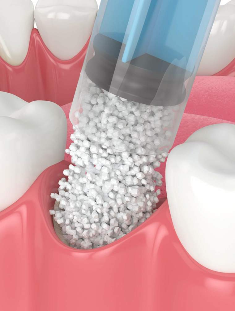 Dental bone graft material in syringe above tooth model during implant procedure demonstration.