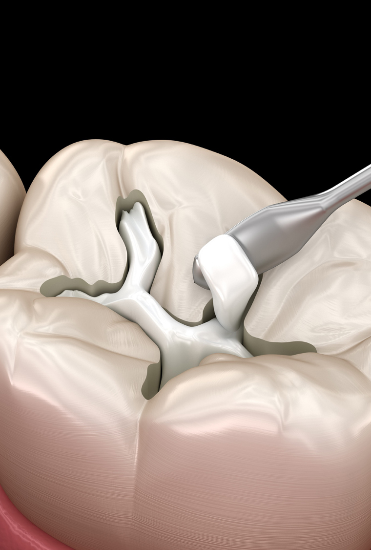 Dental model showing tooth anatomy and internal canal structure for endodontic treatment education.