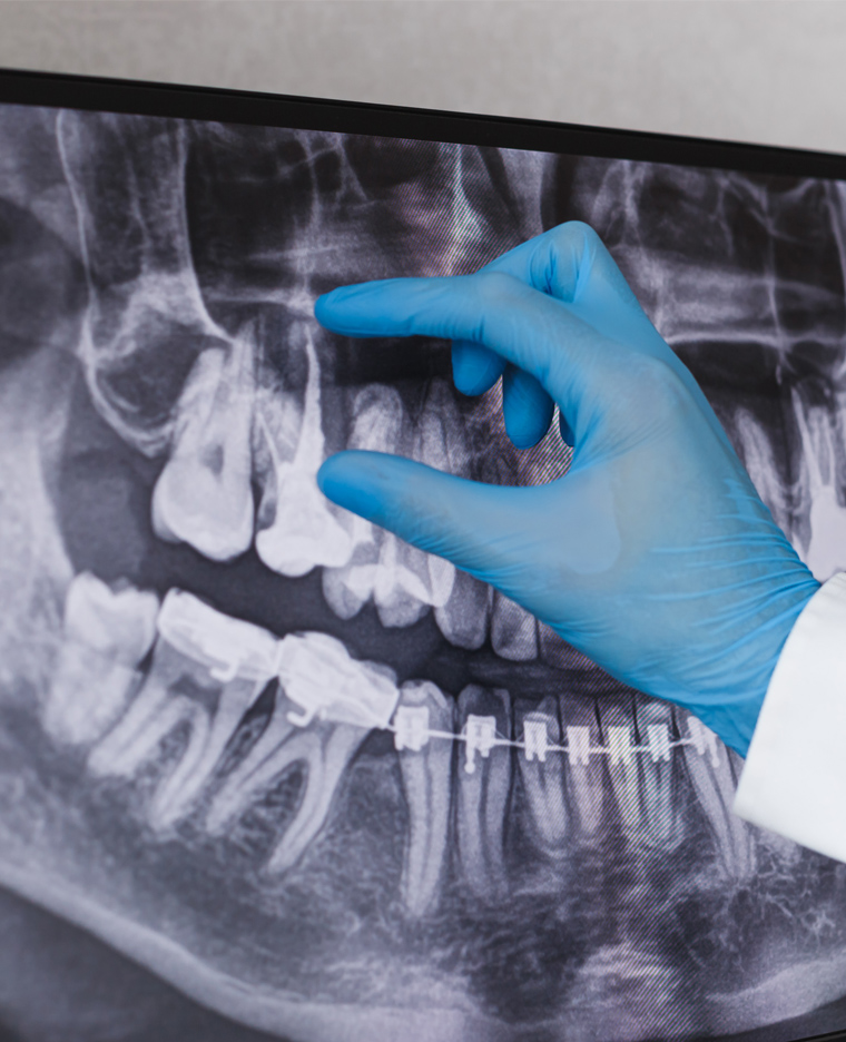 Dentist in blue glove pointing at dental X-ray showing teeth and jaw structure.