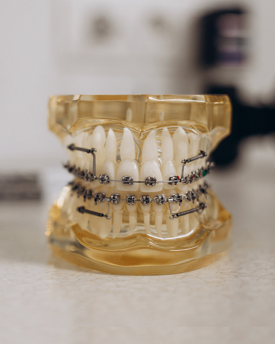 Dental model showing teeth with orthodontic braces and brackets applied.