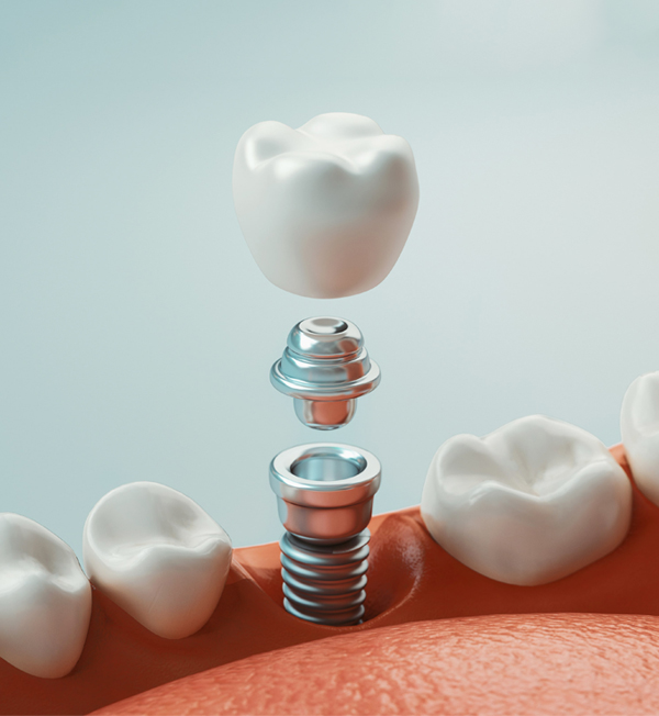 Dental implant diagram showing components: crown, abutment, and screw fixture in jawbone model.