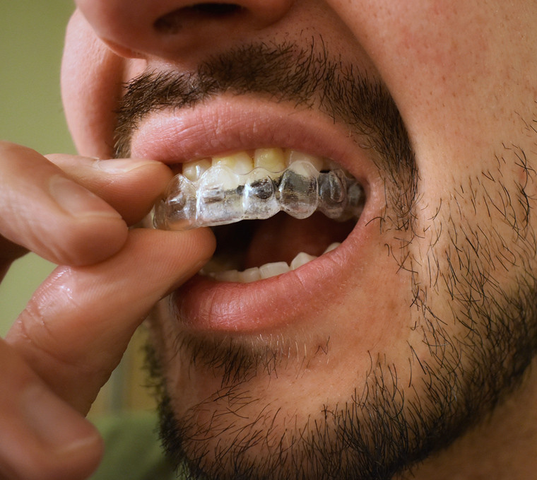 Man inserting clear aligner into mouth, demonstrating orthodontic treatment procedure.