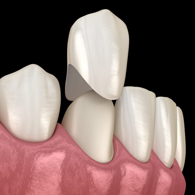 Dental crowns displayed on pink gum model showing tooth restoration and cosmetic dentistry solutions.
