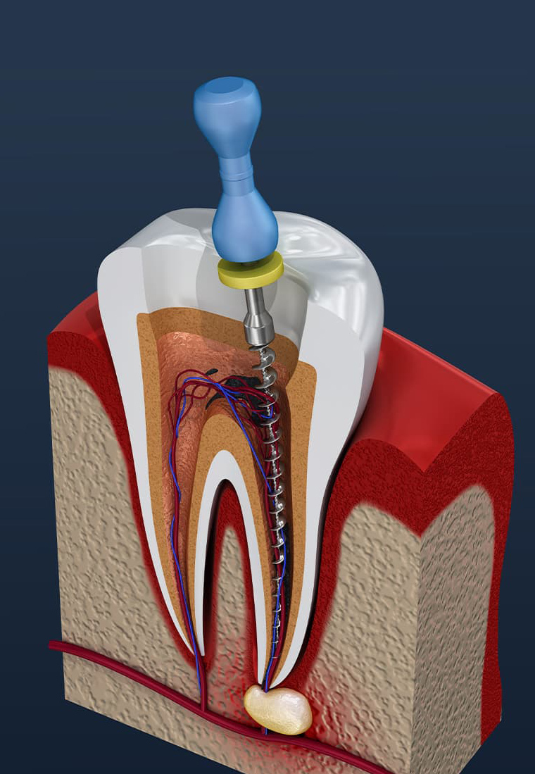 3D dental model showing tooth anatomy with endodontic treatment and blue syringe injection.