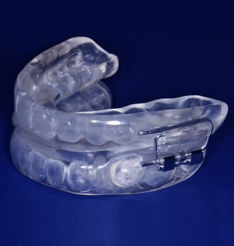 Clear mandibular advancement device shown against blue background for sleep apnea treatment.