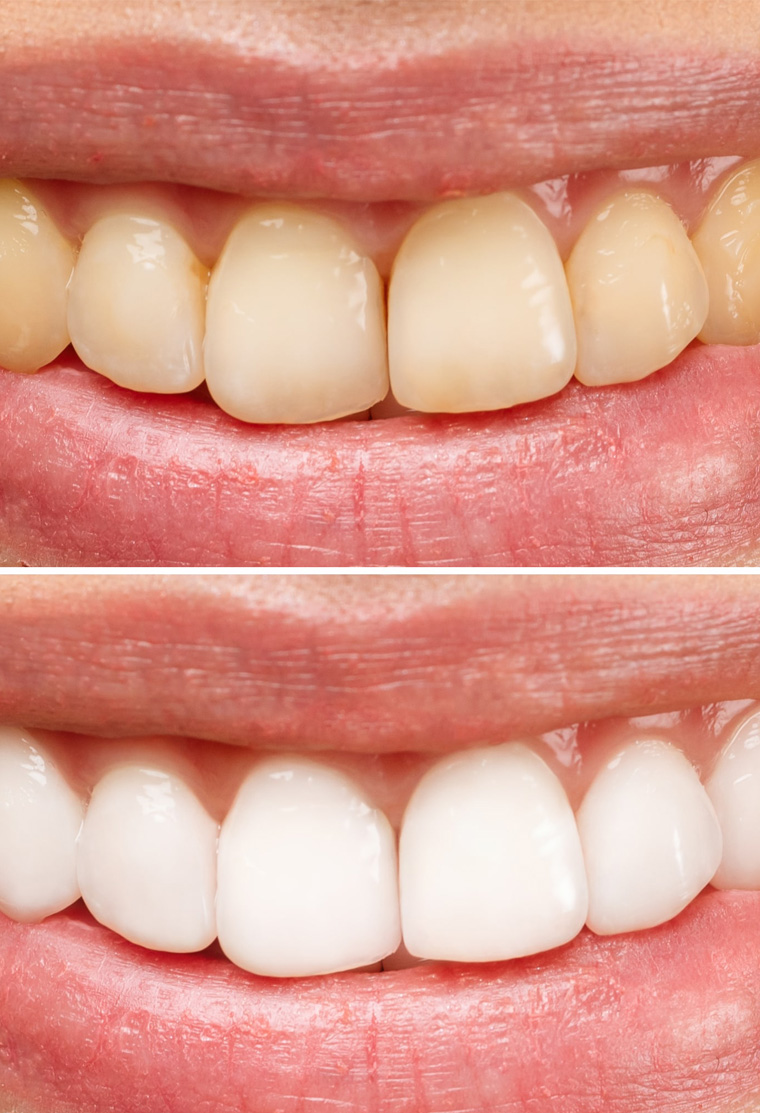 Before and after comparison of teeth whitening results showing improved tooth brightness and whiteness.