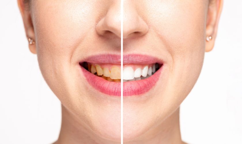 Teeth Whitening Delano